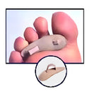 Pack of 3 Toe Crests, relieves forefoot pain and supports gait, Moovkart