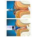 Acu-Life Earwax Removal Syringe with Tri-Stream Tip and Flared Over-Insertion Guard