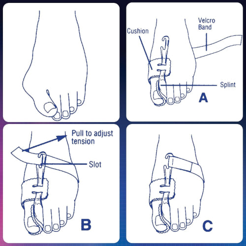 PediFix Bunion Regulator, Medium, Right