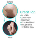 Vive Health Gel Heel Socks, Toeless, Hydrating Oil Blend for Cracked Heel Relief, 2 Pairs
